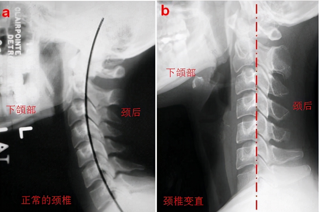 如何缓解颈部疼痛和僵硬,如何缓解颈部的症状