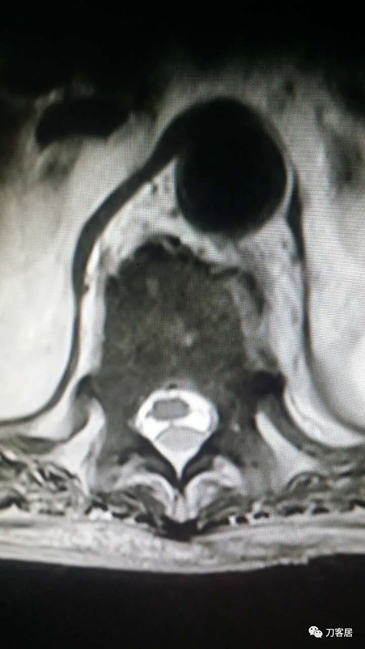 腰椎手术切掉棘突,腰突微创后出血肿