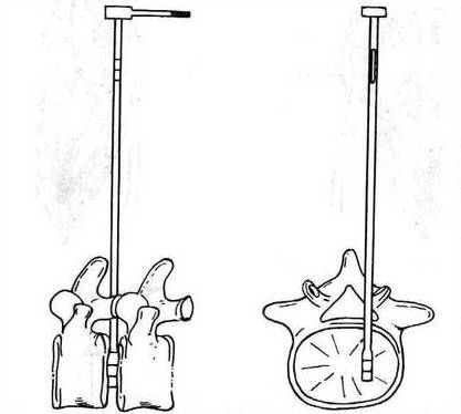 腰椎间盘突出症的临床诊治策略,腰椎间盘突出症的临床诊治