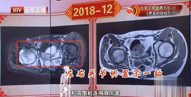 关于骨头的炎症有哪些,骨头关节快速消炎消肿的最好方法