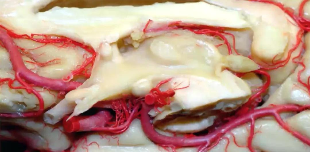 INC巴特朗菲教授视频|视神经-下丘脑胶质瘤全切案例集及治疗解读