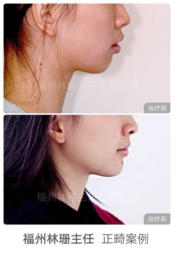 福州牙齿矫正林珊主任｜浅谈下颌后缩