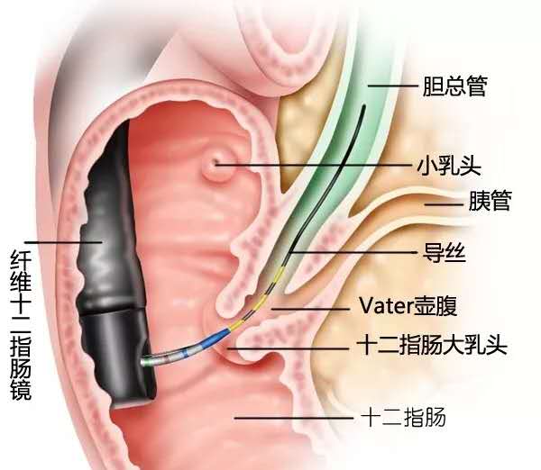 肝内胆管结石怎么治疗,肝胆管结石中医治疗