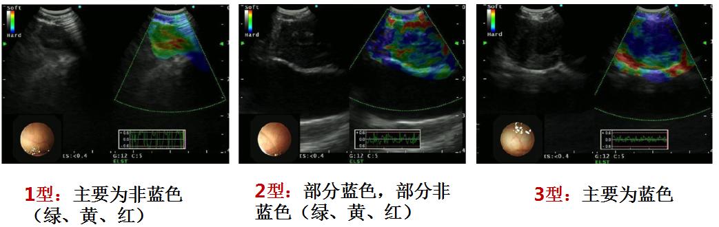 小细胞肺癌的气管镜介入治疗,导航支气管镜在肺癌诊断中的应用