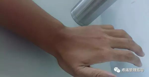 网球肘能自我恢复吗,网球肘病因的解剖学研究