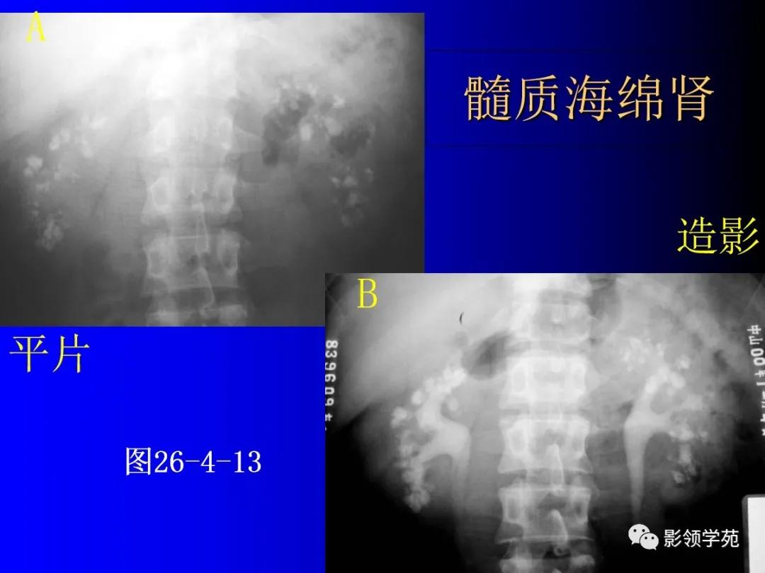 肾脏囊性肿块的影像学特点,肾脏典型病理图片及解析
