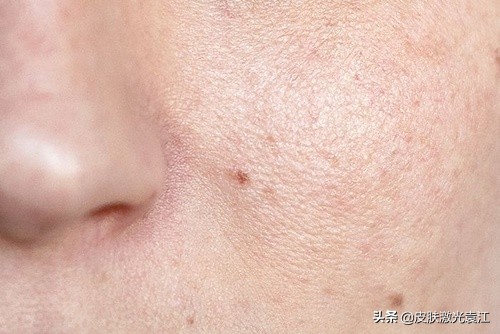 毛孔粗大5种类型改善方法,毛孔粗大程度分级