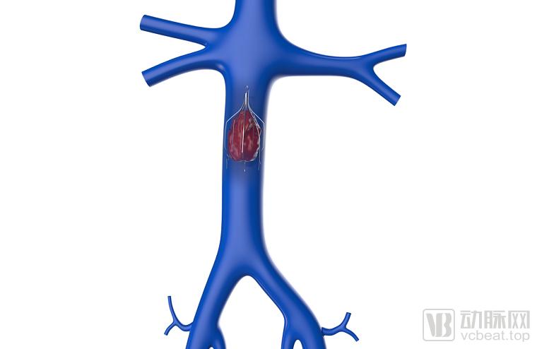 2019年中国血管介入类市场规模,外周血管介入市场规模