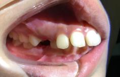 8岁的孩子能做牙齿矫正吗,7岁孩子矫正牙齿早吗