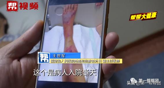 买鱼被鱼刺中截肢,手指被鲈鱼鳍扎伤