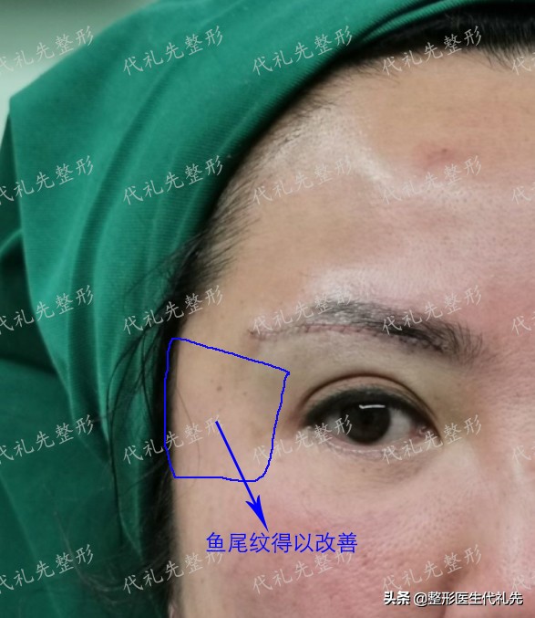 提眉手术的说法,提眉整形问答