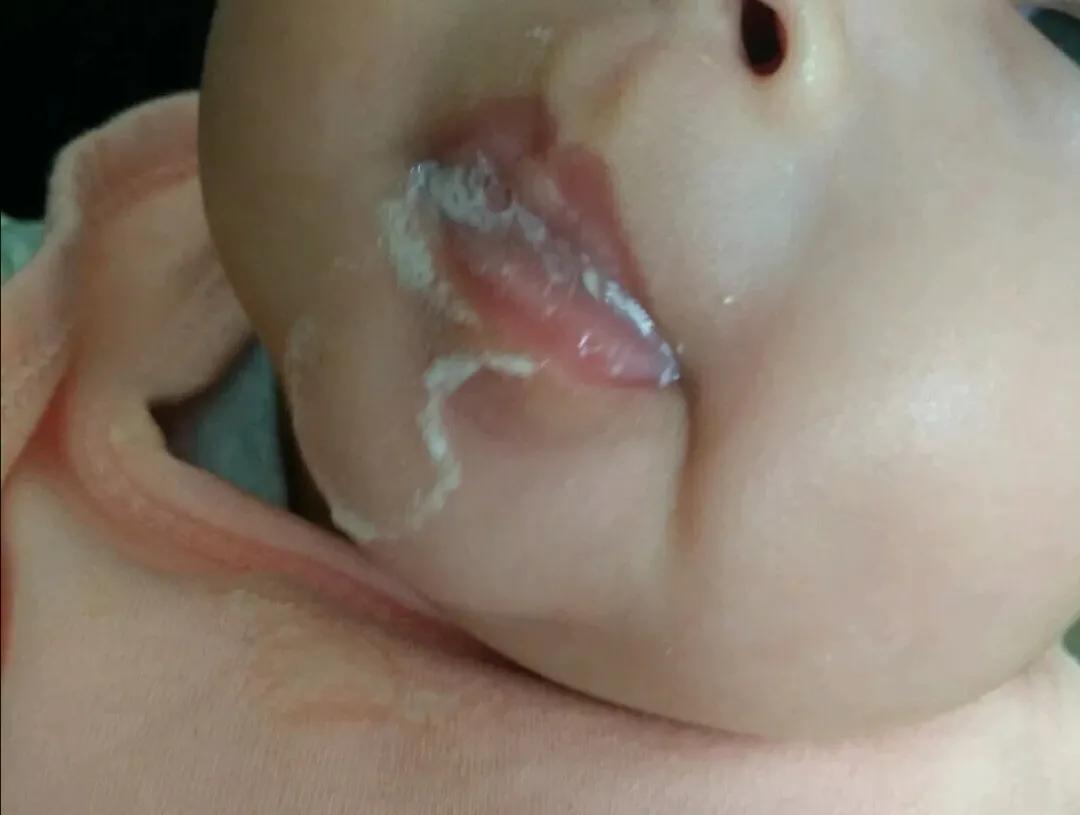 宝宝容易吐奶是神经发育的问题吗,婴儿吐奶跟喉软骨发育不全有关吗