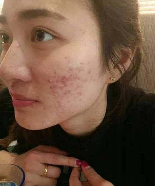 脸上长痘的位置分别代表什么,脸上不同部位长痘分别代表什么