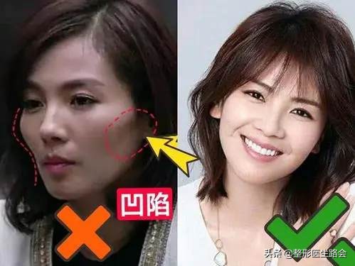 颧骨高到底需不需要整容,颧骨高到底要不要磨骨