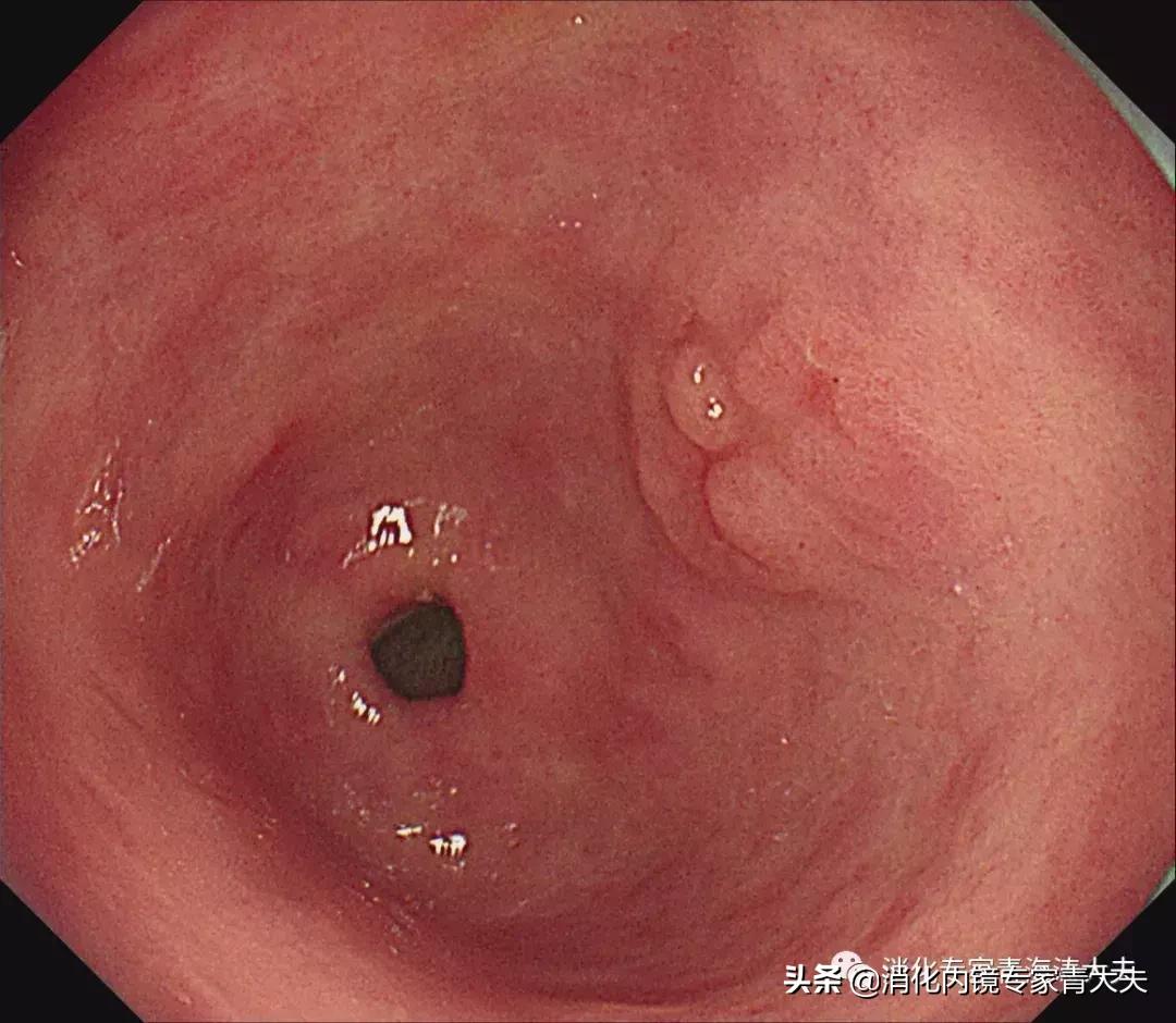 通过科普文章求治的一例胃窦后壁早癌