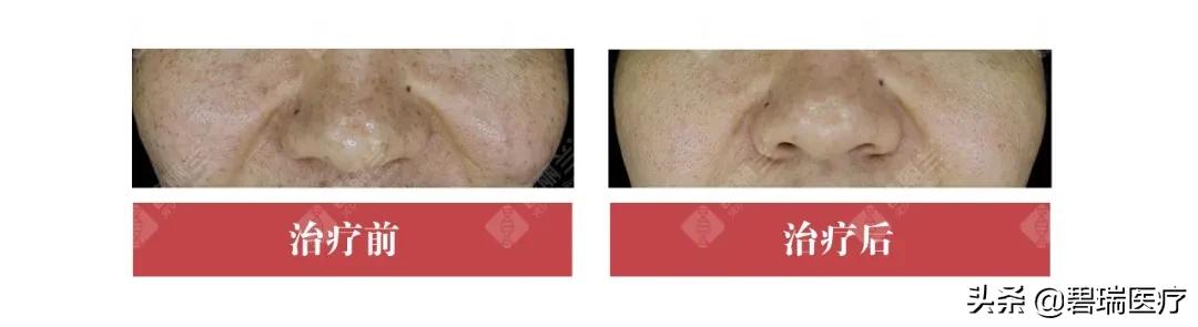 普丽兰pdrn再生2.0,普丽兰pdrn三重作用