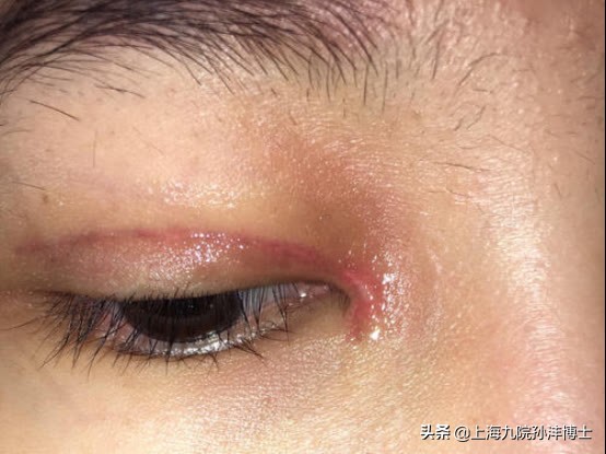 双眼皮修复眼角出现多层疤痕,医生推荐的双眼皮术后祛疤