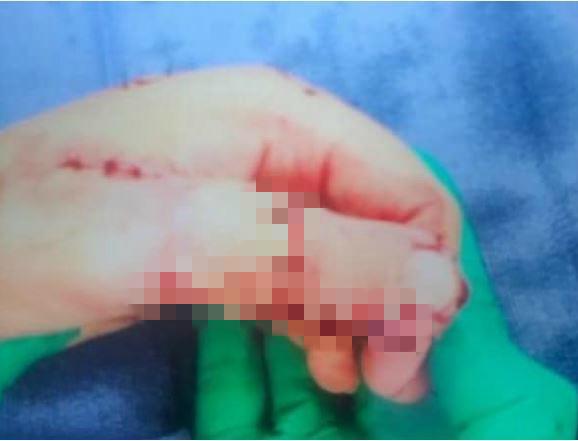 医生忘取止血带，澳洲女运动员被迫截断拇指用脚趾代替，生涯尽毁