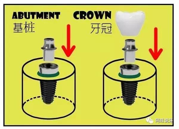 种植牙图片漫画,3d动画2分钟全面了解种植牙全过程