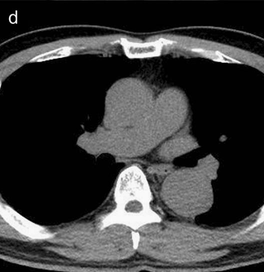 肠系膜上动脉夹层,心脏动脉夹层破裂