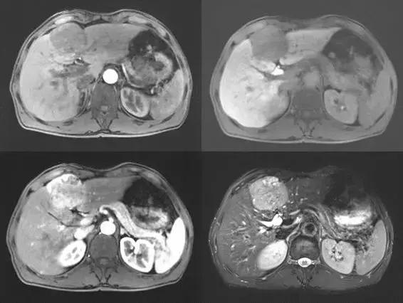 tace治疗肝癌的术后并发症,针对原发性肝癌的tace治疗是指