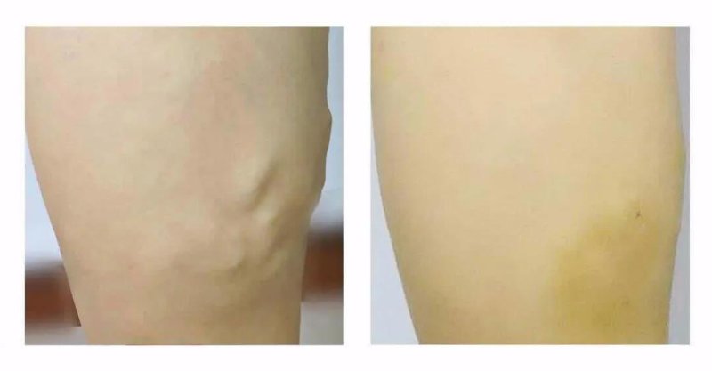 年轻女孩腿部静脉曲张,有年轻的女性得静脉曲张吗