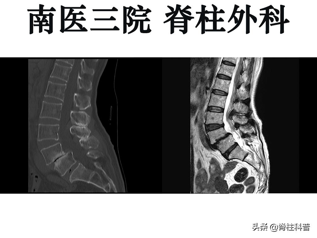 峡部裂导致滑脱有没有痊愈的可能,青少年峡部裂做哪种手术最好