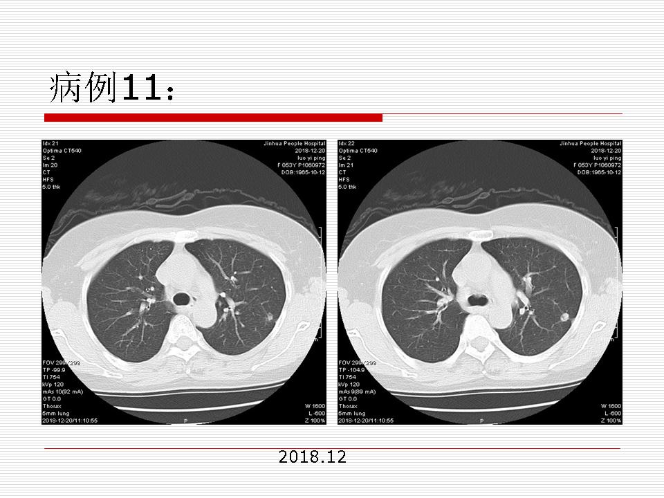 像炎症的肺癌能治好吗,医生说可能是肺癌也可能是炎症
