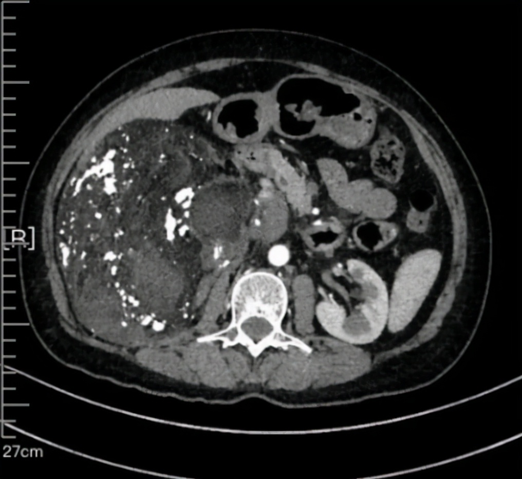 罕见脂肪肉瘤,高分化腹膜后脂肪肉瘤能治好吗