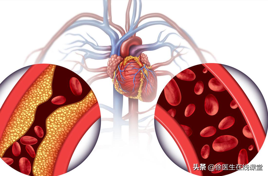 血粘度高吃脂必妥管用吗,血粘度偏高吃阿司匹林吃多久停药