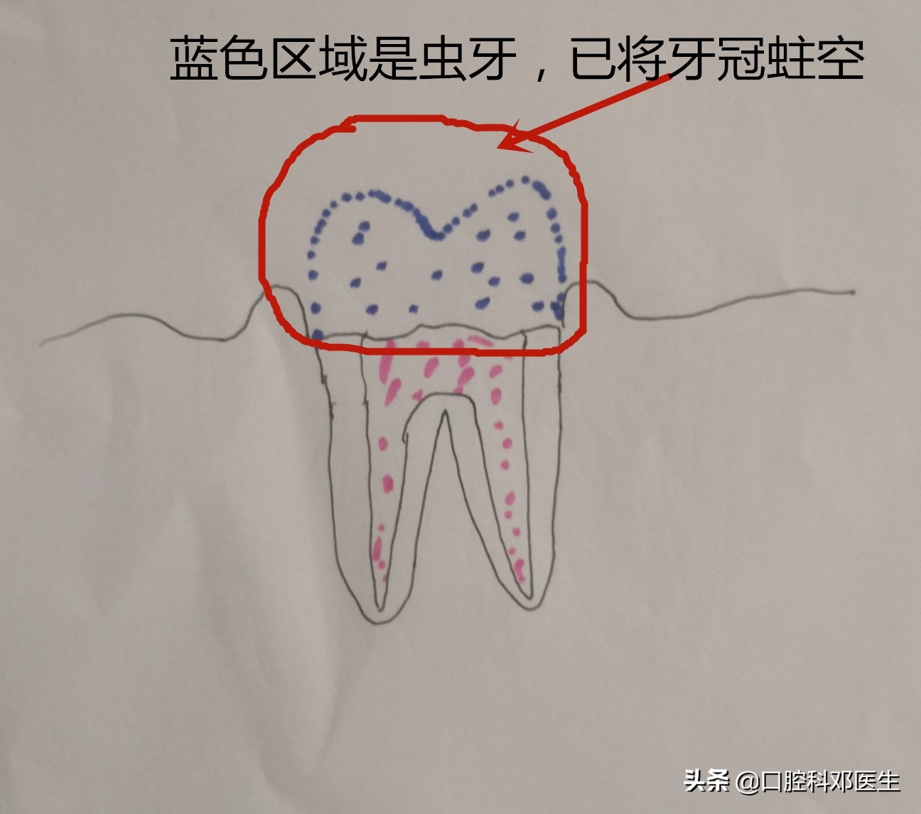 虫牙补牙方法有几种,虫洞露牙补牙的正确方法