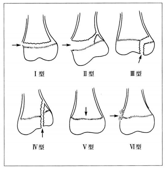 小孩腿部骨折后对身高有影响么,小孩骨折长大后有影响吗