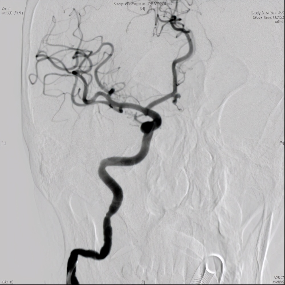 舌下神经受损症状图片,舌下神经损伤后的表现怎么治疗