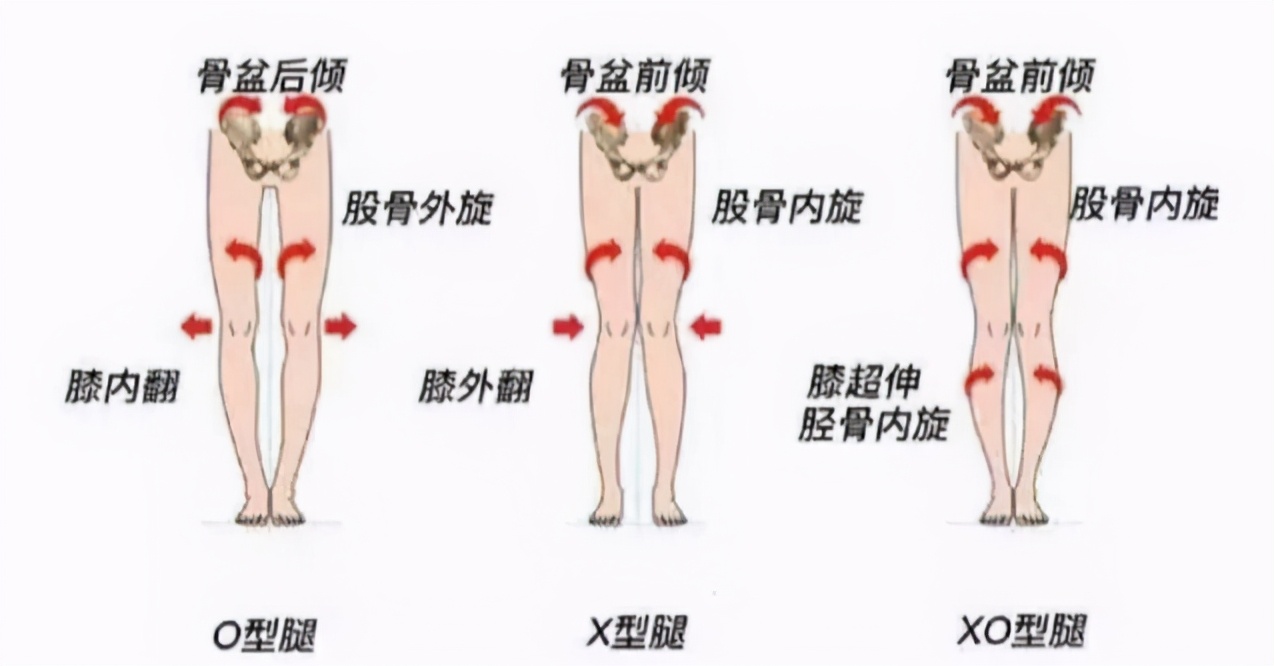 穿纸尿裤对孩子腿型有影响吗,小时候腿不正长大后会矫正吗