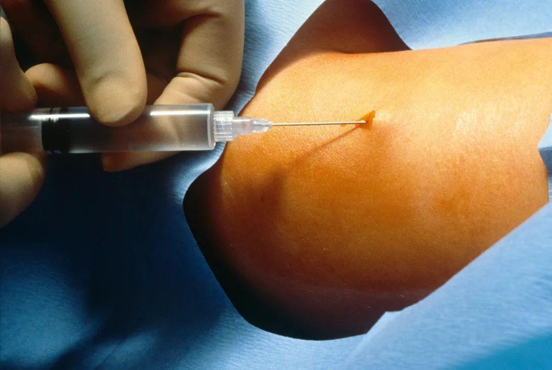 常用且有效的避孕方式是什么,详细介绍各种常见的靠谱避孕方式