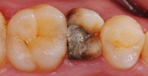 不洗牙去除牙结石的实用方法,牙结石特别严重如何洗牙