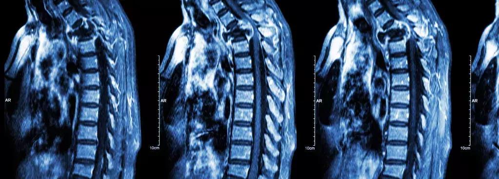 核磁与ct哪个更准,脑ct和脑核磁检查结果