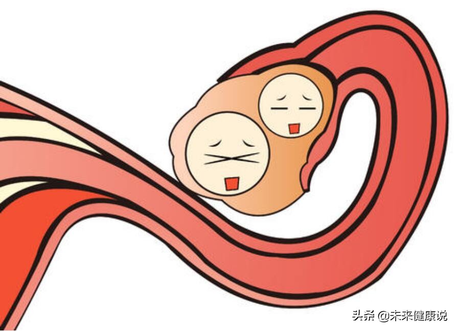 左下腹疼痛女性可能是黄体破裂吗,女子腹痛黄体破裂