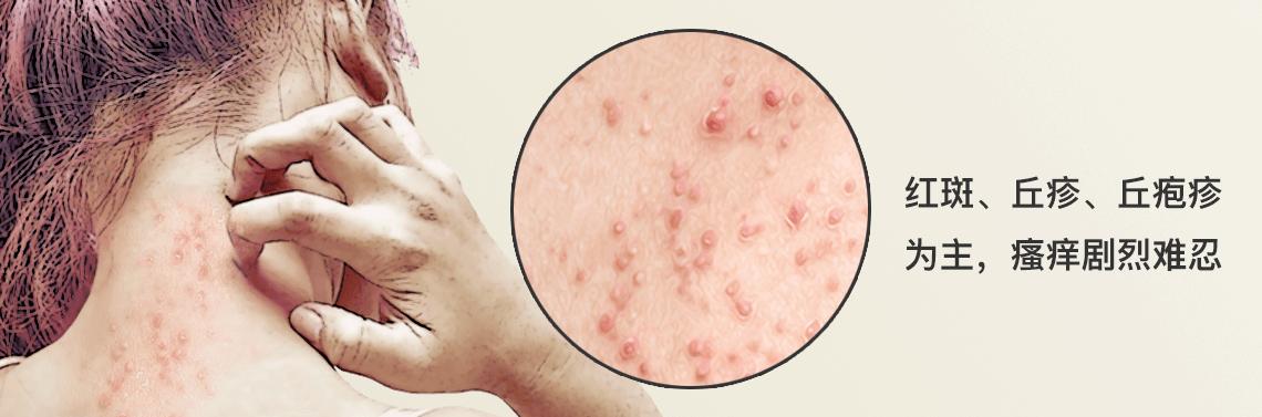 湿疹急性期可选用最适合的药物,5岁孩子药物过敏湿疹严重怎么办
