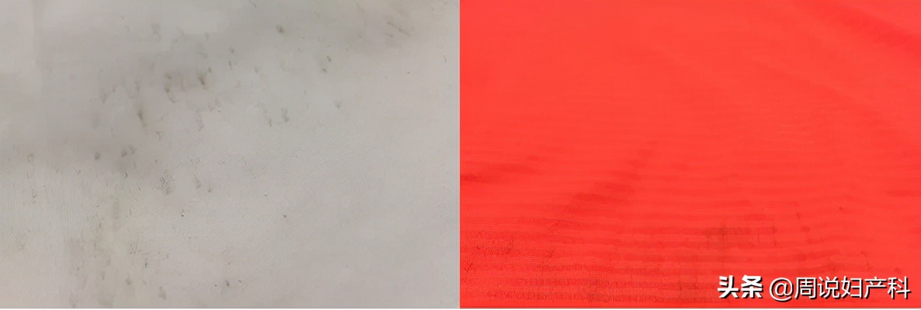 为什么内衣裤霉斑变多了,为什么裤子上穿久了会起霉点