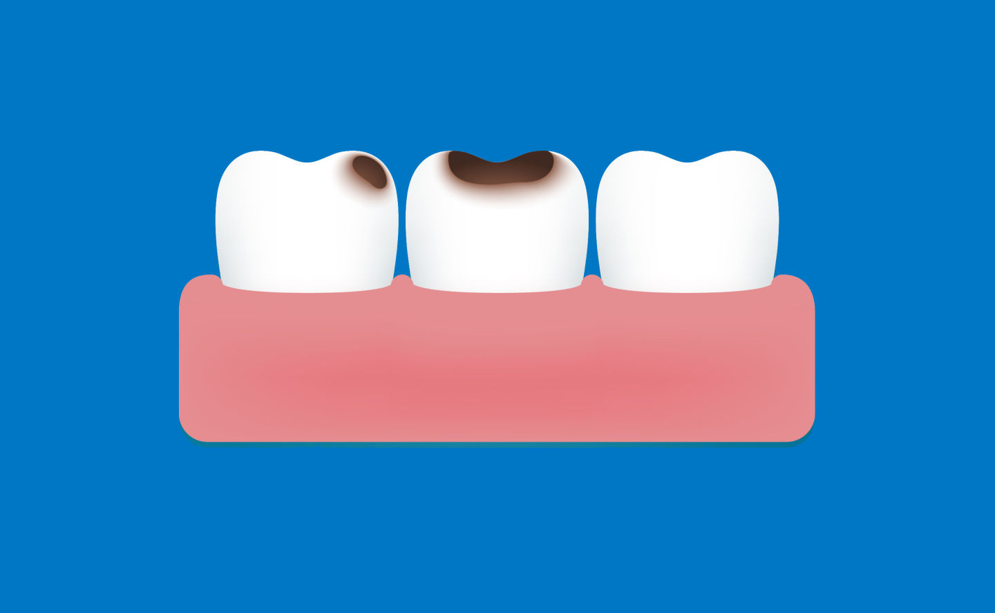 小孩牙齿蛀牙烂掉还会长出来吗,补过的牙齿还会蛀牙吗