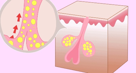 油性肌肤的六大护肤步骤,油性肌肤有粉刺如何护肤