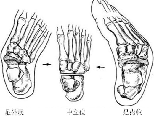 足内翻矫正鞋真的可以矫正吗,马蹄内翻足矫正鞋要穿多久