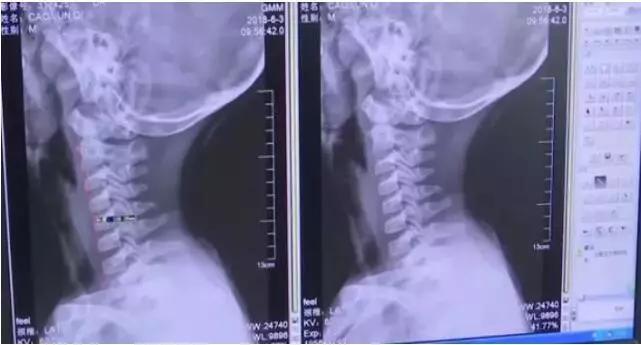 5岁孩子近视200度能矫正吗,5岁的孩子眼睛散光200度怎么回事