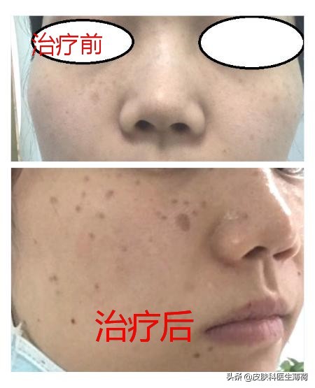 皮秒激光祛雀斑效果图,激光祛痘坑效果