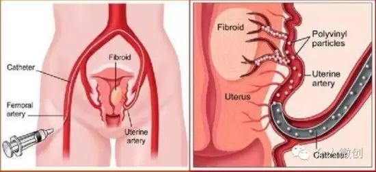 子宫肌瘤6cm可以怀孕吗,当怀孕遇到了乙肝该怎么办