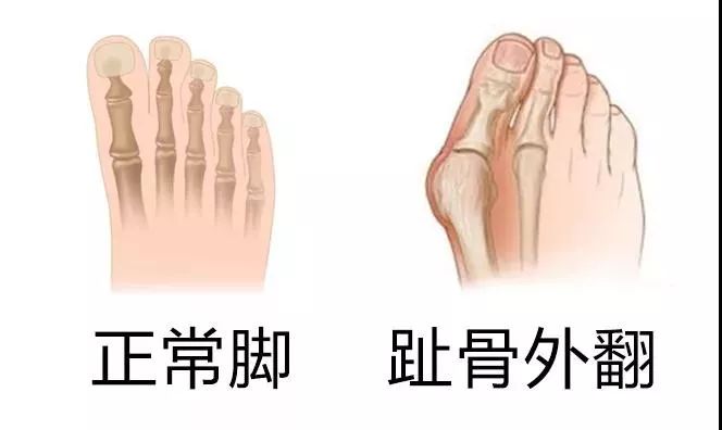 宽脚胖脚穿的鞋子,宽脚胖脚穿尖头鞋