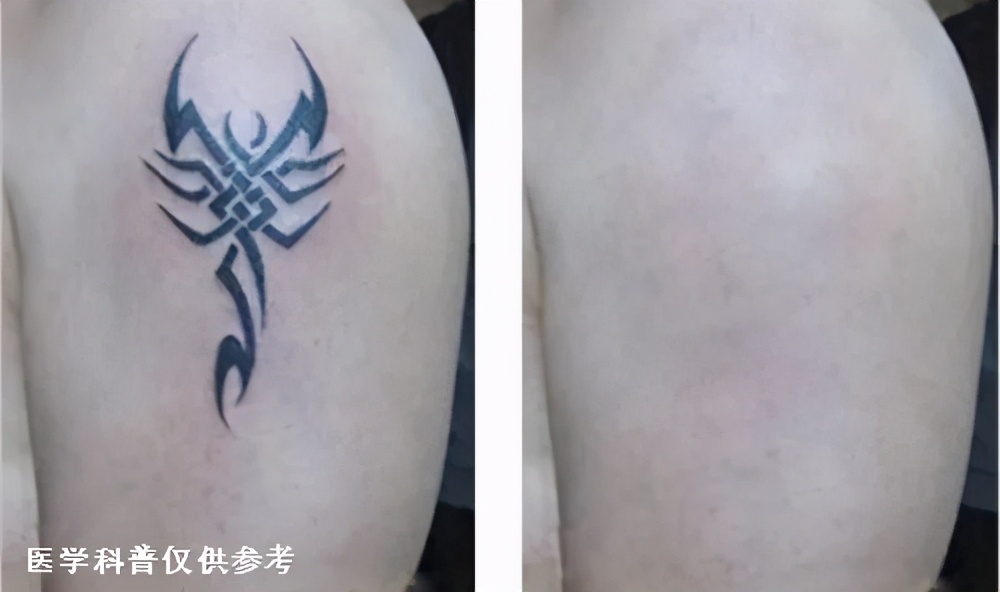 激光祛纹身的正确方法,激光快速祛纹身方法