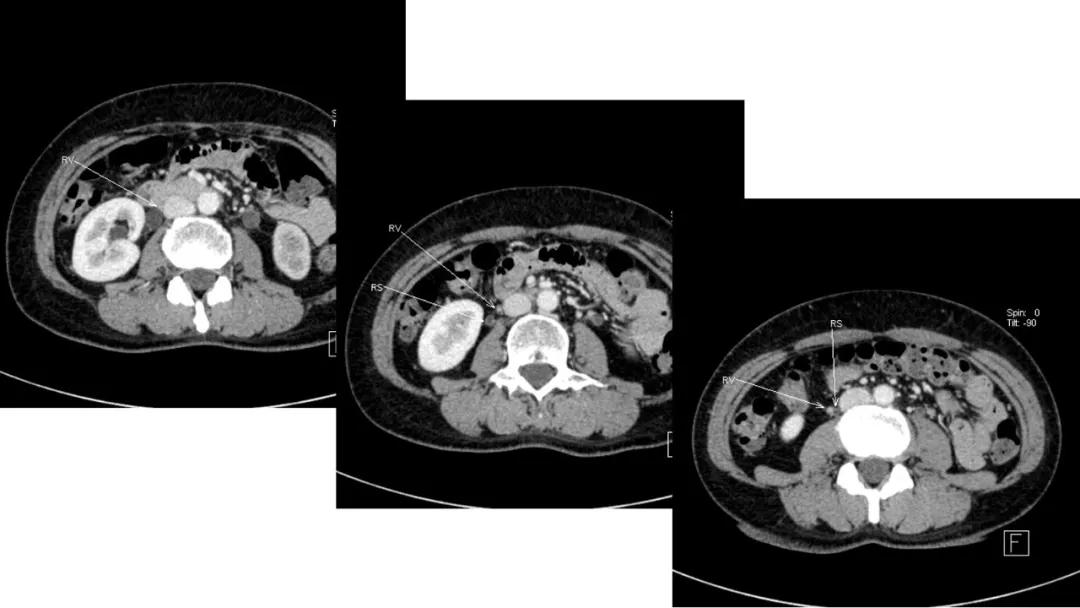 卵巢原发肿瘤的分析思路