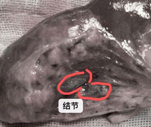 肺部结节半年增大1毫米是肺癌么,肺部有1.11cm结节是肺癌吗